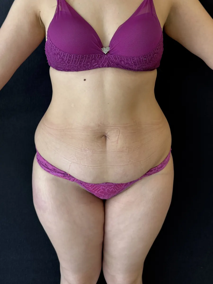 Abdominoplastia, caso 2, vista de frente, antes da cirurgia