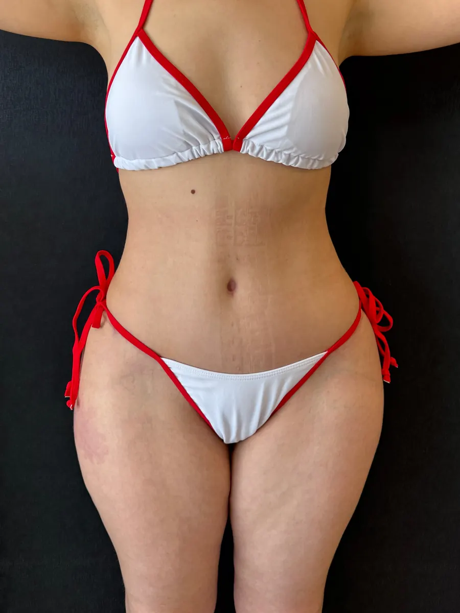 Abdominoplastia, caso 2, vista de frente, depois da cirurgia
