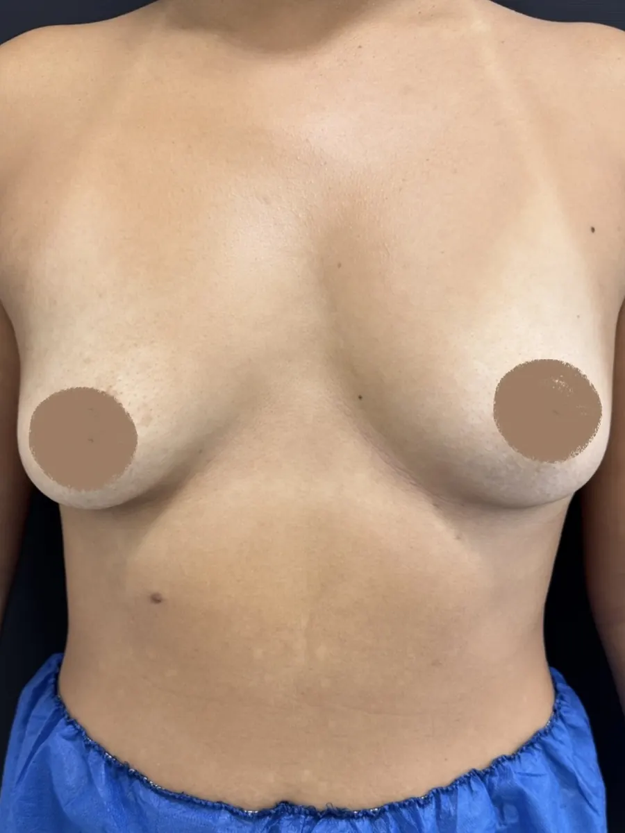 Cirurgia das Mamas, caso 1, vista de frente, antes da cirurgia