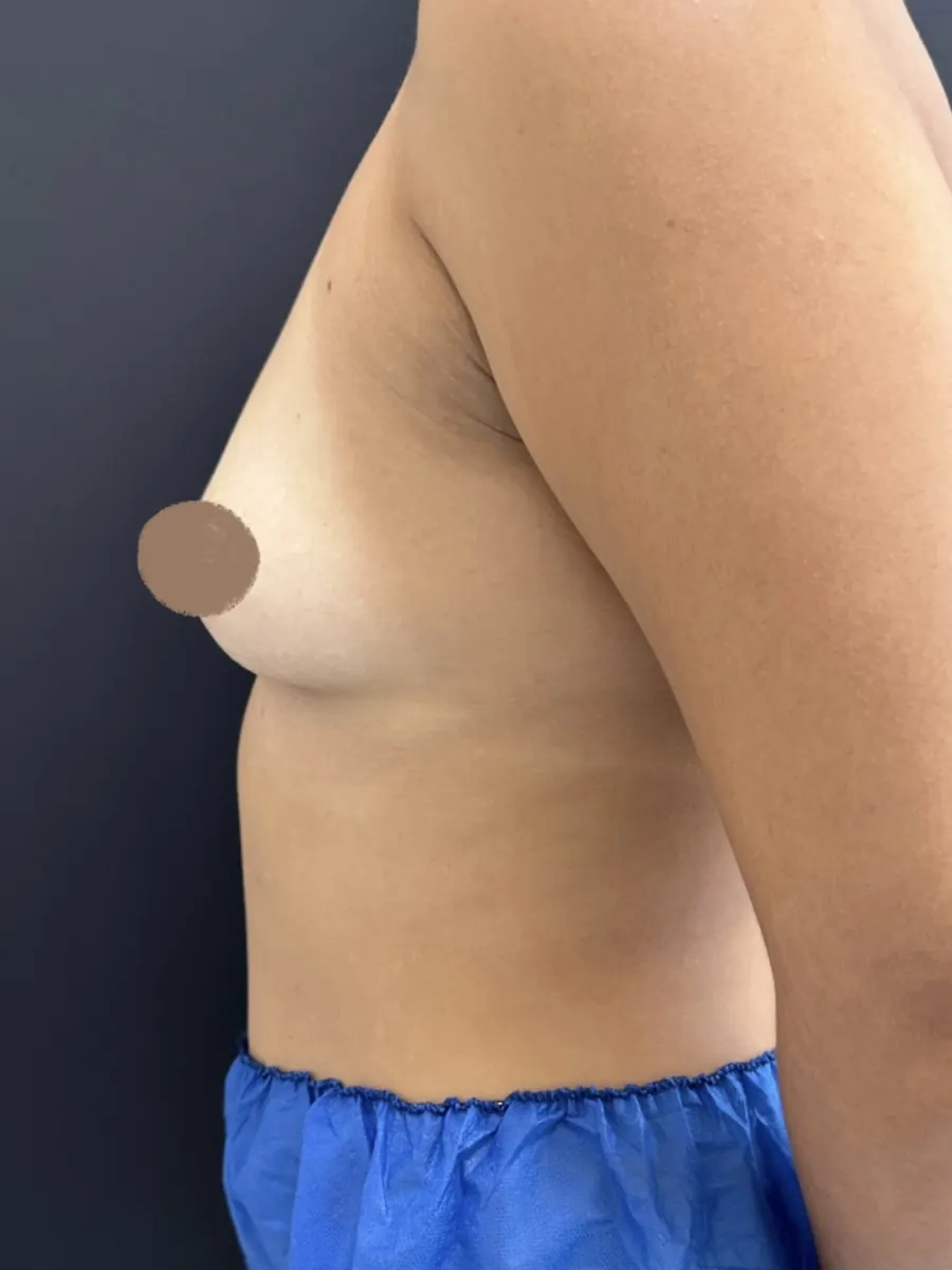 Cirurgia das Mamas, caso 1, vista de perfil, antes da cirurgia