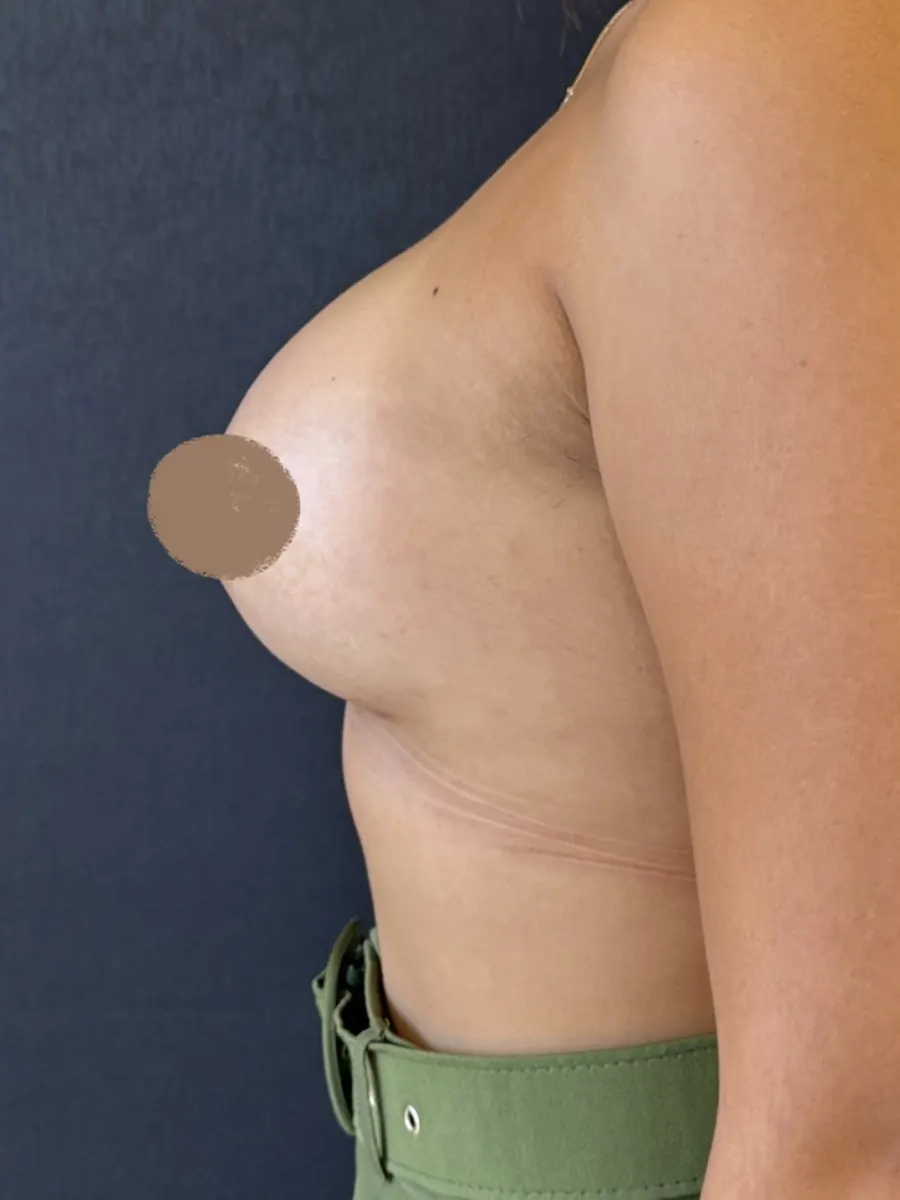 Cirurgia das Mamas, caso 1, vista de perfil, depois da cirurgia