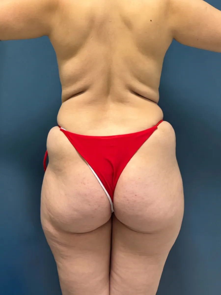 Flancoplastia, caso 1, vista de costas, antes da cirurgia