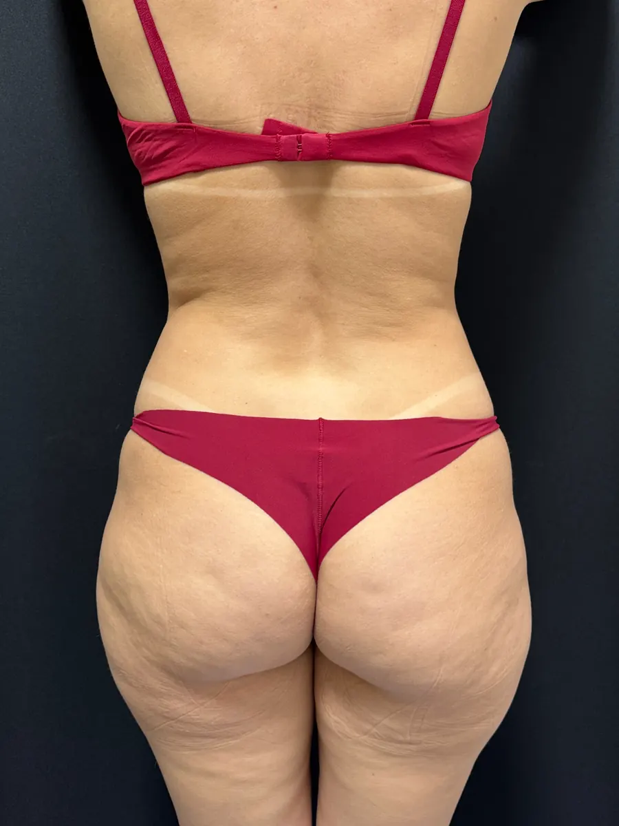 Lipoaspiração, caso 1, vista de costas, antes da cirurgia