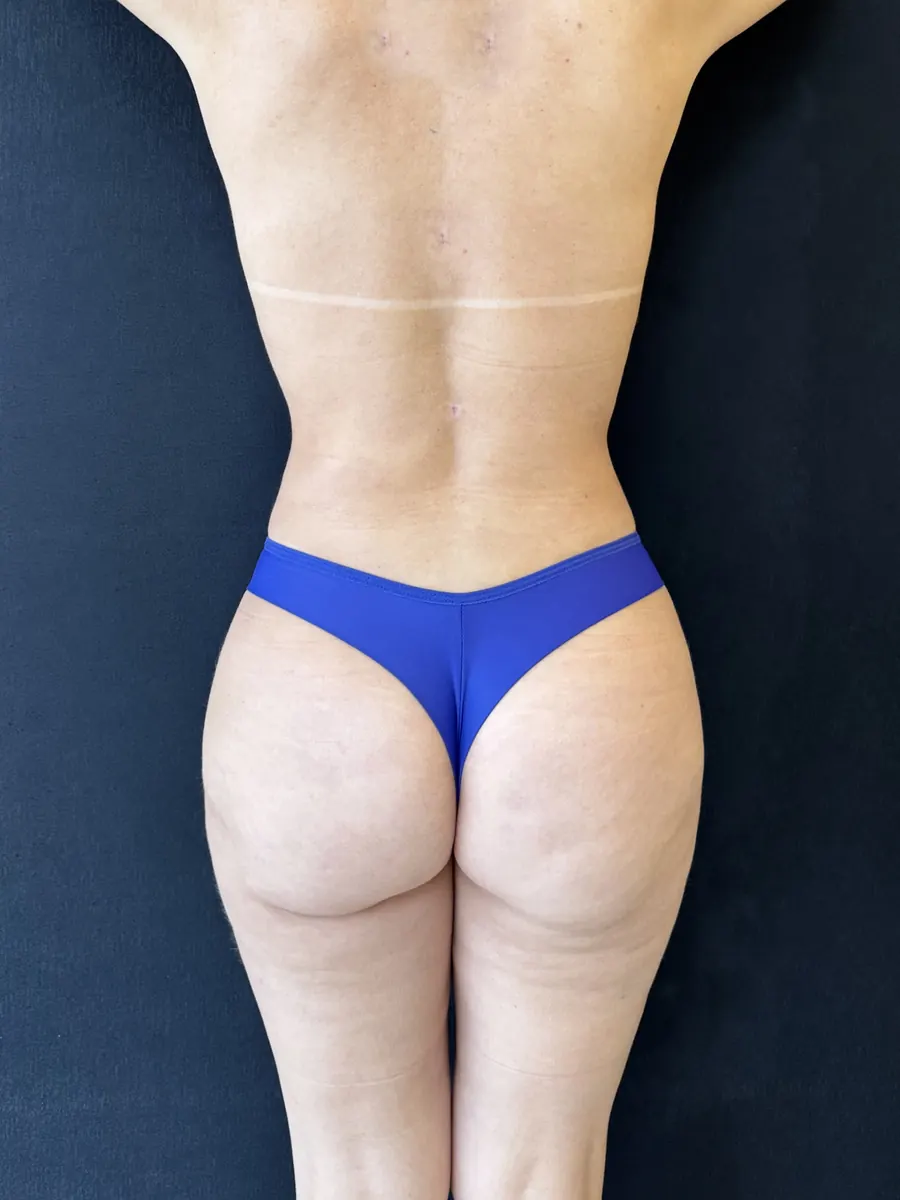 Lipoaspiração, caso 1, vista de costas, depois da cirurgia