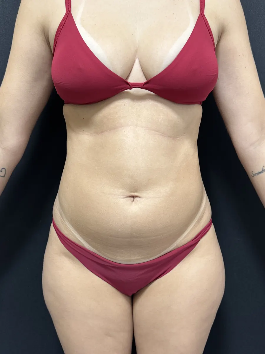 Lipoaspiração, caso 1, vista de frente, antes da cirurgia