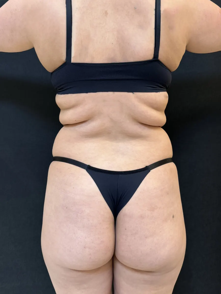 Lipoaspiração, caso 2, vista de costas, antes da cirurgia