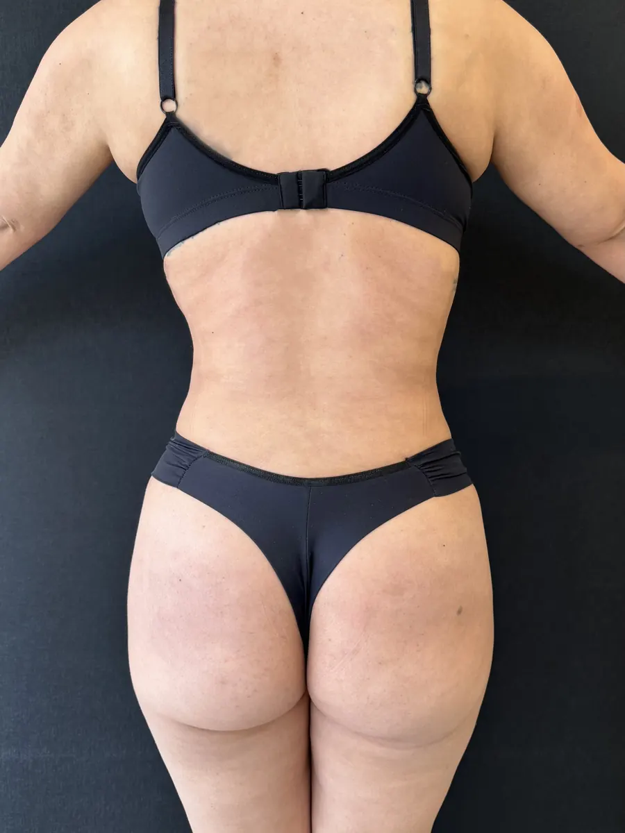 Lipoaspiração, caso 2, vista de costas, depois da cirurgia