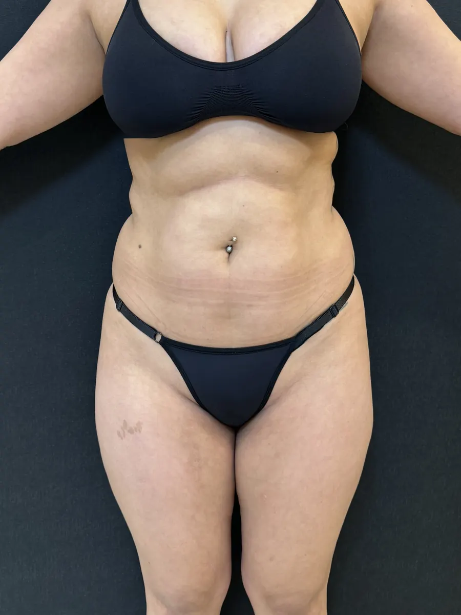 Lipoaspiração, caso 2, vista de frente, antes da cirurgia