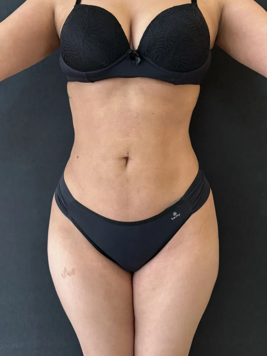 Lipoaspiração, caso 2, vista de frente, depois da cirurgia